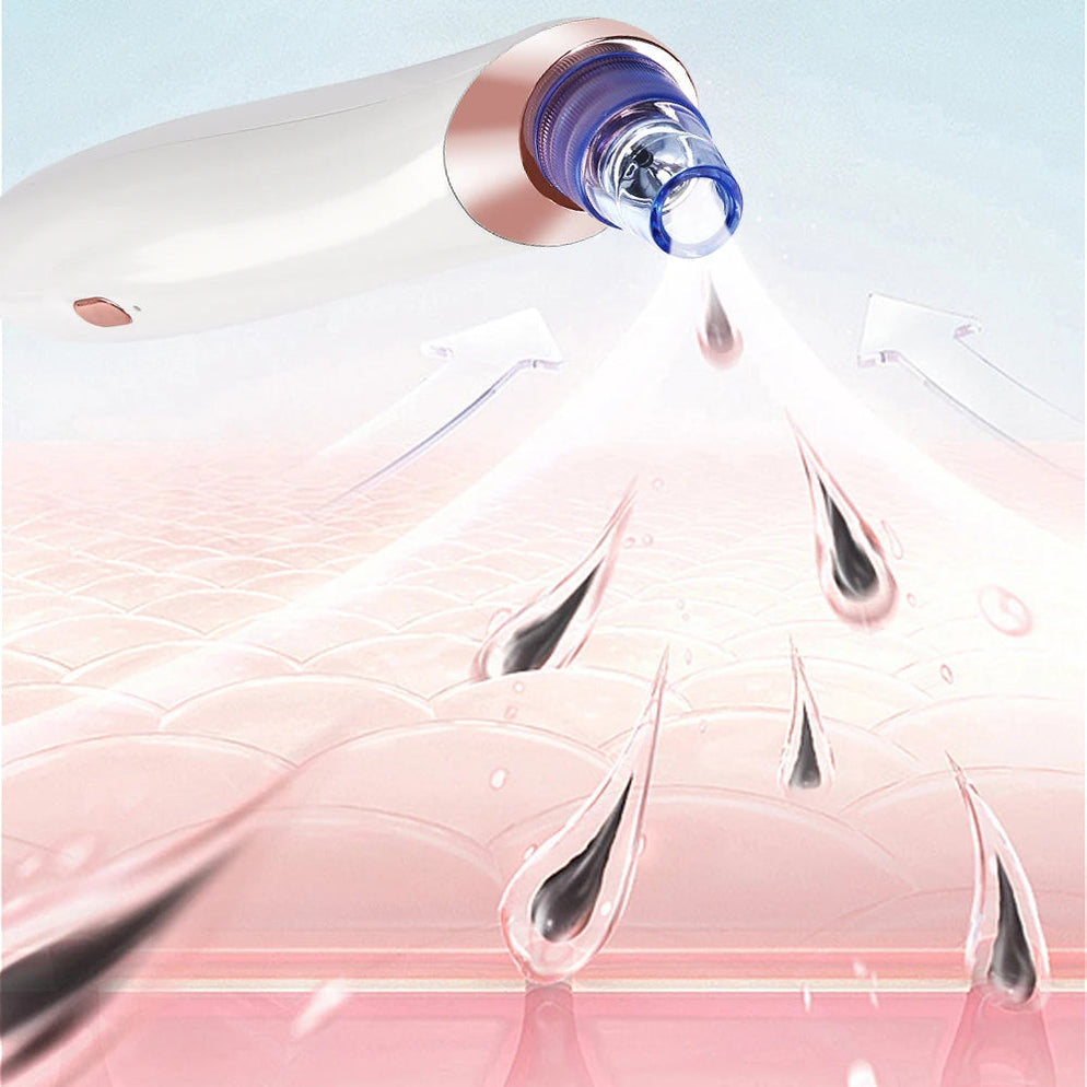 AcneAway™ – Mitesserentferner der nächsten Generation