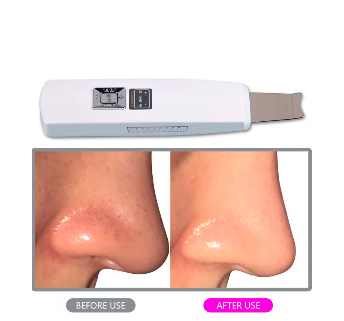 DermiCleanse – Ultraschall-Spatel-Gesichtsreinigungsgerät